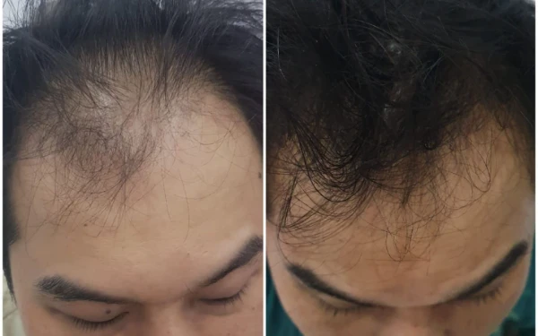 Foto Kondisi rambut Andy, suami dr. Okta sebelum dan sesudah treatment eksosom. (Foto: ABL)