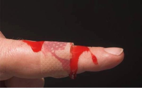 Thumbnail Berita - Kasus Hemofilia di Indonesia Masih Minim Terdeteksi, Baru 13 Persen Terdiagnosis