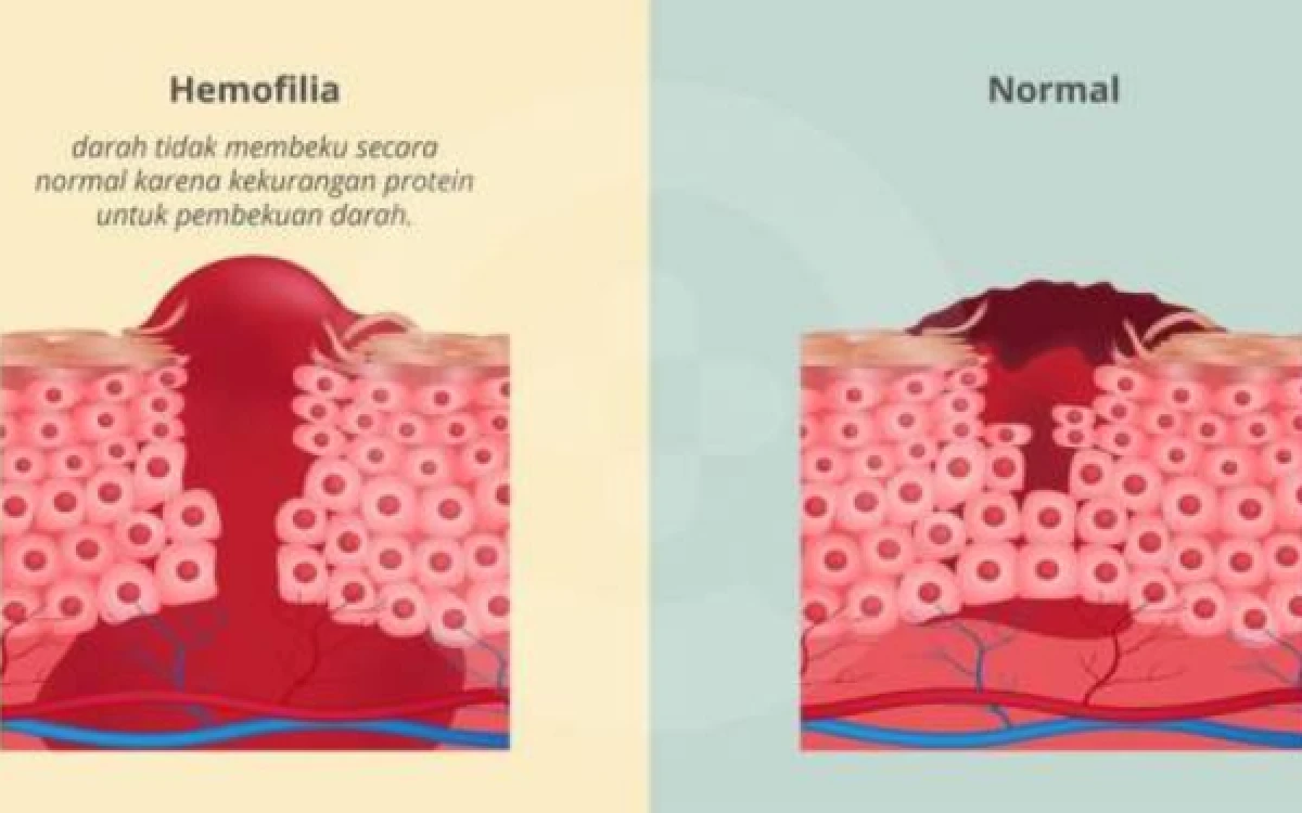 Thumbnail Berita - Gejala Hemofilia yang Sering Tak Disadari, dari Nyeri Sendi hingga Perdarahan Internal
