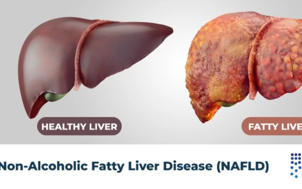Thumbnail Berita - Fatty Liver Kini Banyak Menyerang Usia 30-an, Kerap Dijuluki Silent Killer